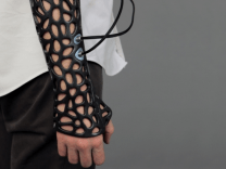 A 3D Printed Cast That Can Heal Your Bones 40-80% Faster