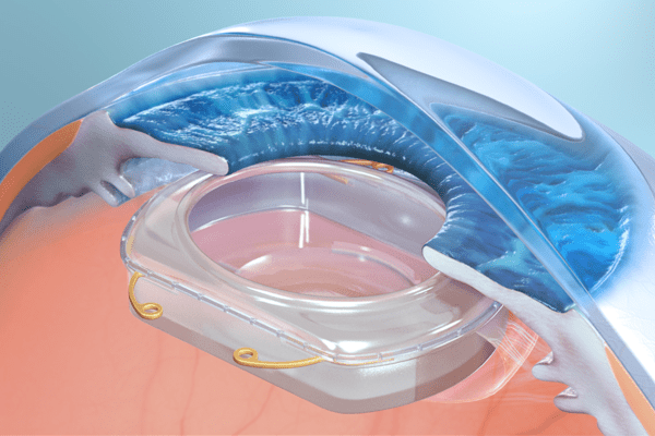 Omega Ophthalmics is an eye implant platform with the power of continuous AR